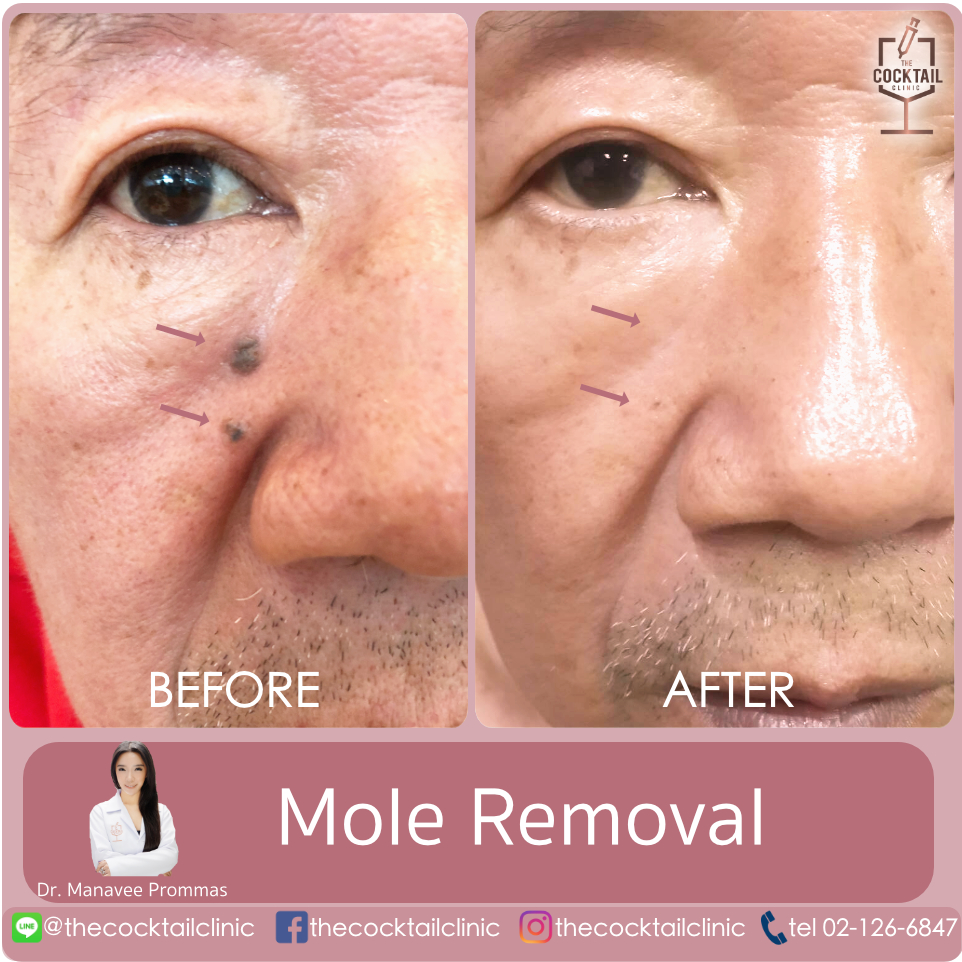mole removal the cocktail clinic